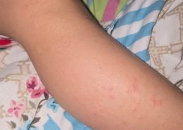 Bebeğimin vücudunda alerjik kırmızı yaralar çıkmaya başladı ne yapmalıyım?