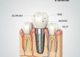 Devlet hastanesinde implant diş yaptıranların son durumu nedir? Memnunlar mı?
